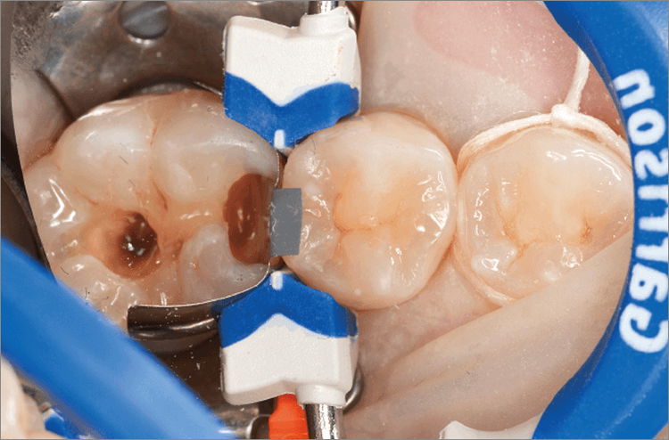小臼歯のダイレクトボンディングを終え、大臼歯へマトリックスならびにリテーナーを設置。
