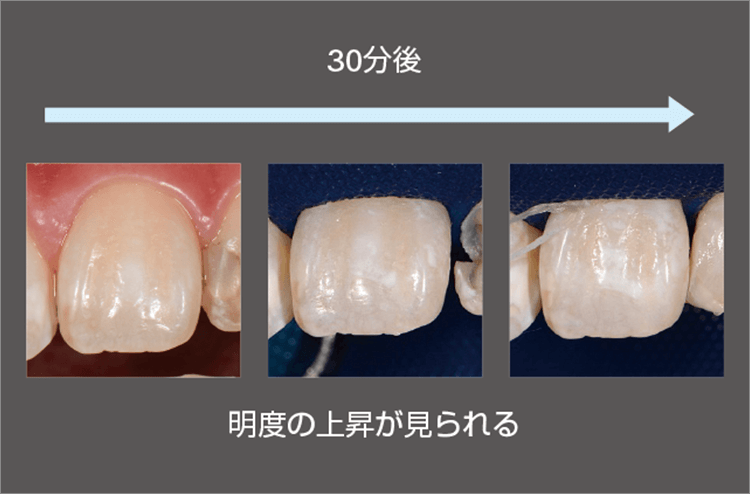 ラバーダムによる明度の変化。30分ほどであるが、明度が上昇しているのが見てとれる。