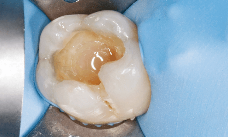歯髄近接部のみ2ミリ程度の厚みで、バルクベースでの充填を行った。