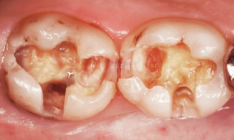 感染歯質の完全除去後。