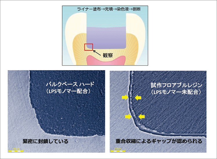 バルクベースは重合収縮が少ないことから、コントラクションギャップが生じにくい。（サンメディカル社提供）