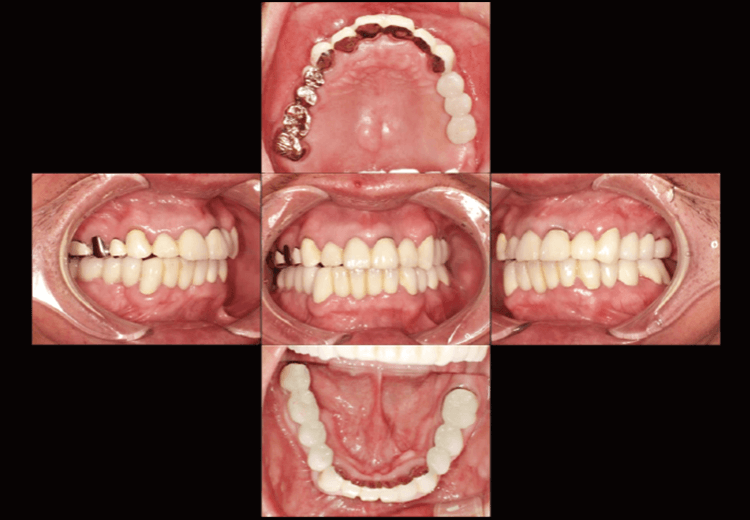 同時期の5枚法写真。上下顎前歯部、右上ブリッジは保険内での治療だったため、機能的、審美的にはやや不十分である。
