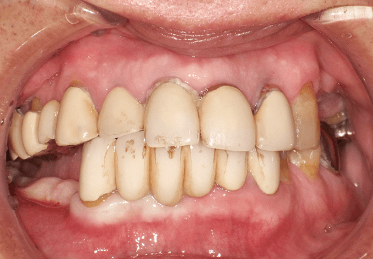 初診時口腔内写真。不良補綴も多く、ペリオ、咬合不正が存在する。