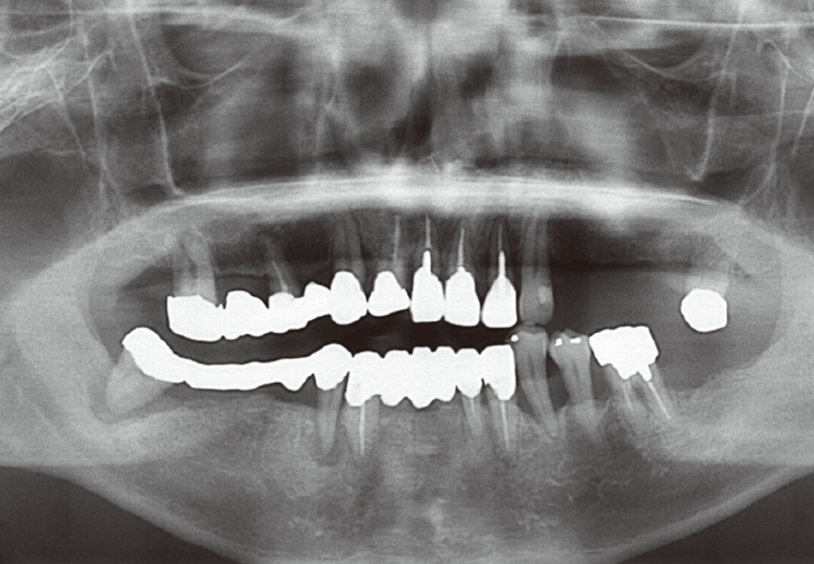 初診時パノラマ写真。全顎的な治療が必要と考えられた。