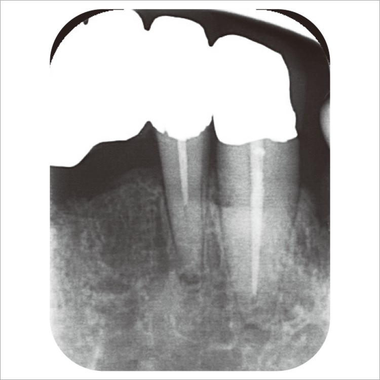 初診時デンタル写真。根管治療の不備で根尖病変が存在。