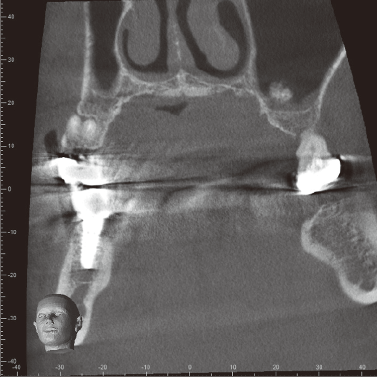右下のインプラント。高解像度のCTを使用することで、皮質骨、海綿骨まで明瞭に見分けることが可能。