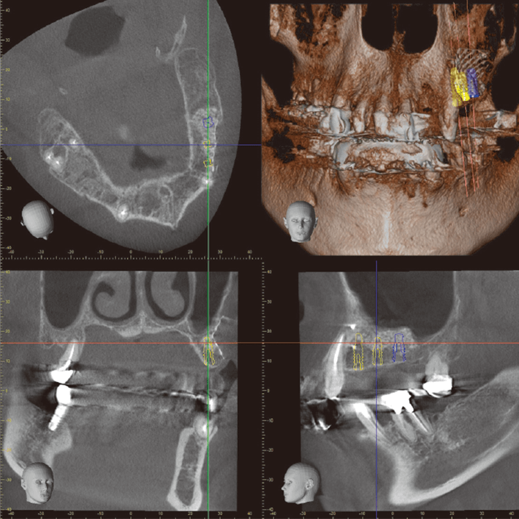 左上インプラントの術前シミュレーション。
