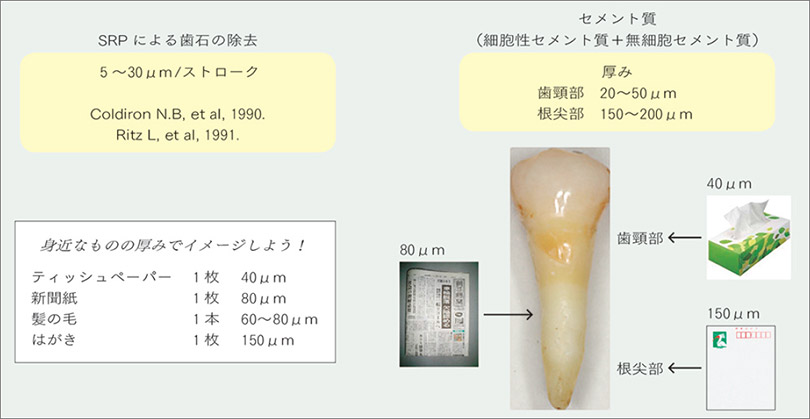 歯のセメント質の厚さの平均とハンドスケーリングでの削除量の図