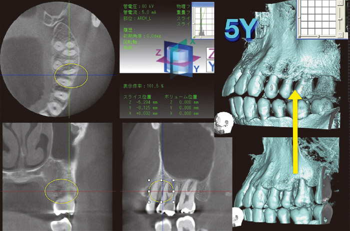 Erbium YAG Laserを用いた歯周外科の処置後5年の状態