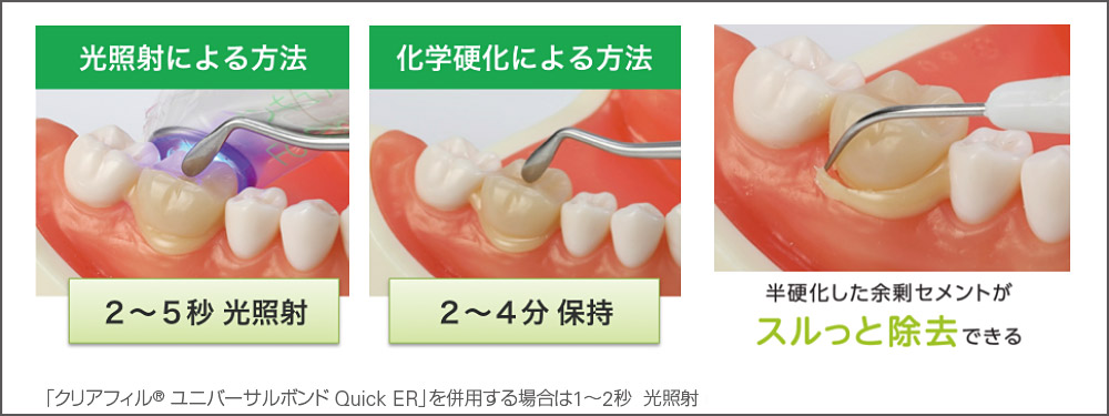 余剰セメントの除去の図