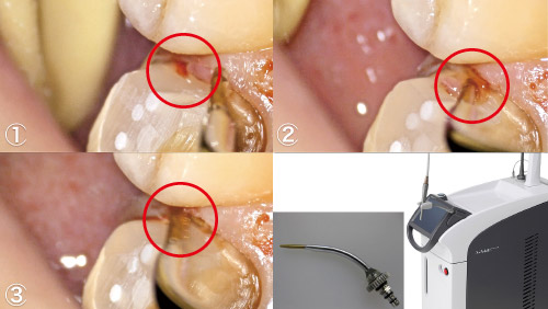 マージンビルドアップが適応症ではない深い歯肉縁下症例の写真