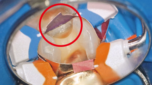 マトリックスバンドと歯肉側マージンに間隙がなく、浸出液、血液が確認されない状態の写真