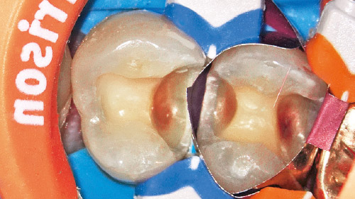 連続歯の症例を1歯ごと確実に施術していく写真