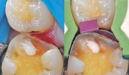 歯面処理を行いビルドアップ、I.D.S法を行う写真