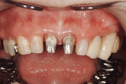 支台歯の状況写真