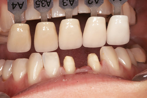 支台歯の状況写真