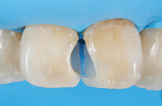 シリコーンインデックスにより再現された口蓋側と切縁側の外形態の写真