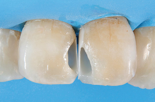 左側中切歯近心壁が再現された写真