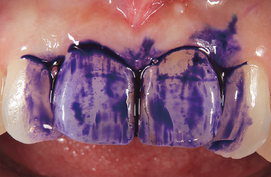 歯垢染色液を用いて治療当該エリアの染め出しを行う写真