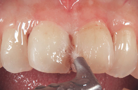 グリシンパウダーが填入されたエアフロー ハンディ3.0（EMS）を用いて徹底した歯面清掃を行う写真