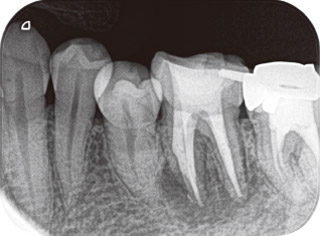 根管充填時のX線写真