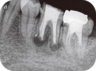 歯根端切除術直後の写真
