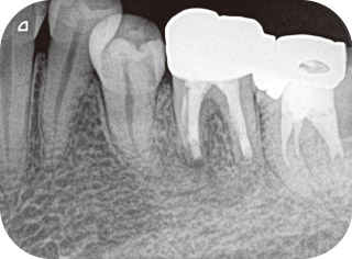 歯根端切除術6ヵ月後の写真