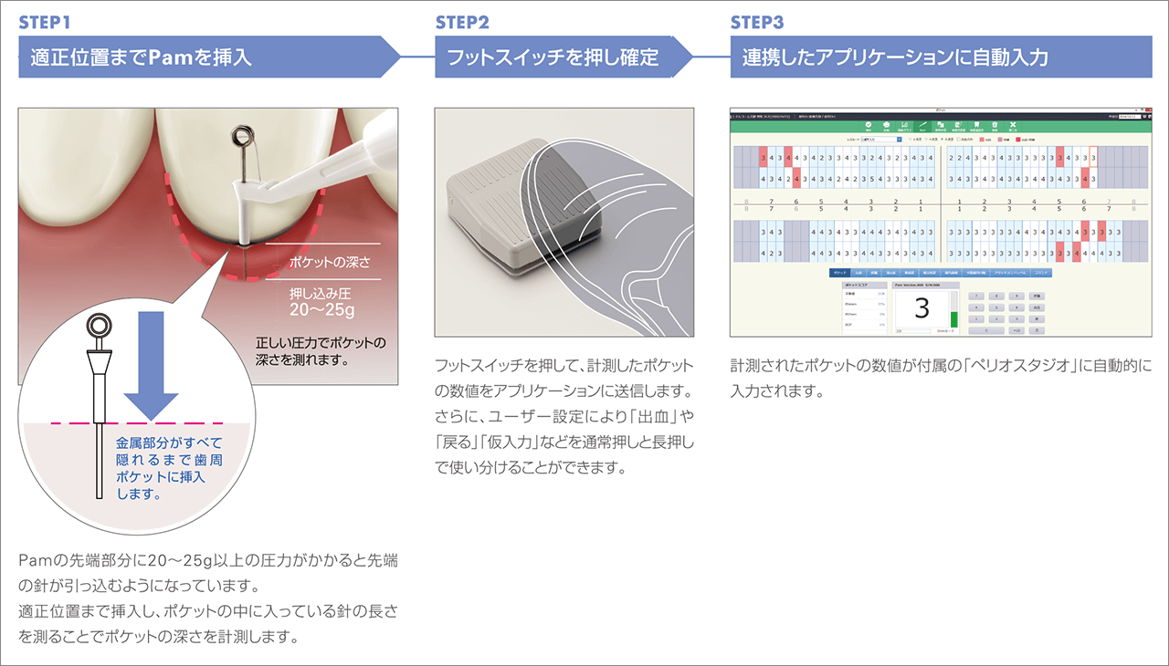 歯周検査入力のイメージ