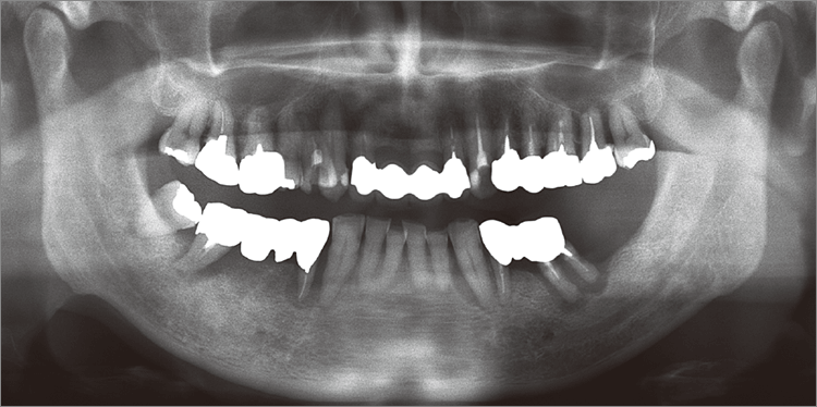 術前のオルソパントモグラフィー画像
