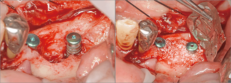 骨補填材をインプラントヘッドまで十分に覆うように填塞