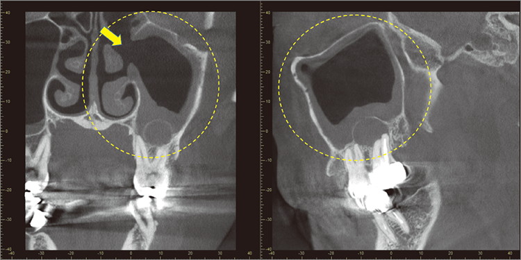 自然孔～筋骨洞を開放した図3の術後CBCT。上顎洞の炎症の有無を診断するためには、眼窩底～眼球の半分まで撮影する必要がある