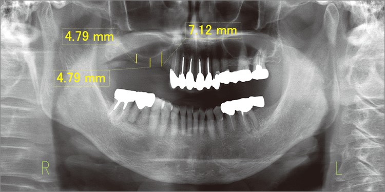 術前のオルソパントモグラフィー画像。14～17部に垂直的残存骨吸収が見られる