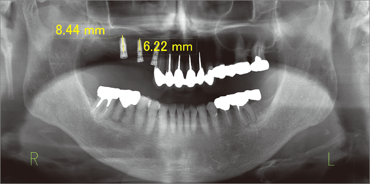 術後のオルソパントモグラフィー画像