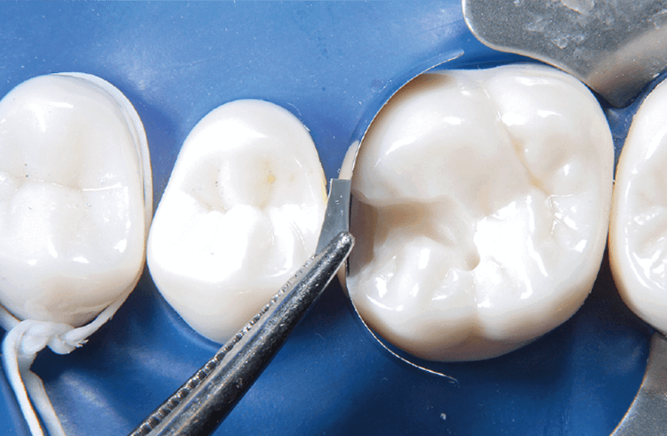 フォーセップスを用いて隣接歯間部にマトリックスを挿入する。治療当該部位のマージンが歯肉側に近い場合は延長部が付与されたマトリックスを推奨する
