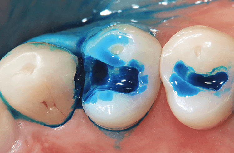 充填物を除去した後に感染歯質の有無を確認するため、う蝕検知液を窩洞に塗布する