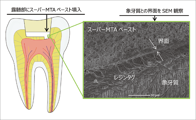 スーパーMTAペーストと象牙質との界面状態のイメージ
