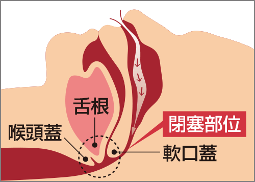 SAS患者の気道閉塞の図