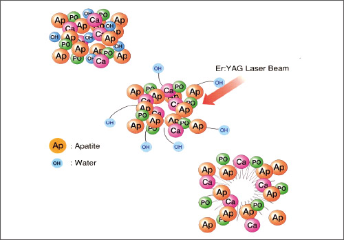 Er:YAGレーザーの硬組織蒸散モデル