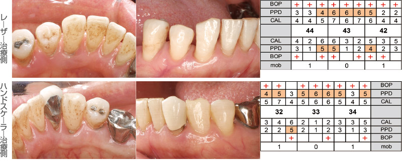 広汎型中等度慢性歯周炎の62歳男性、SRP前の状態