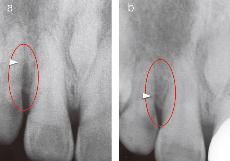 X線画像にて術前は深い垂直性欠損（a）。術後1年では改善がみられた（b）