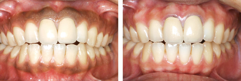 全顎的にEr:YAGレーザー（注水、20Hz、80mJ）で歯肉のメラニン除去を行った症例の術前（左）と術後6ヵ月（右）