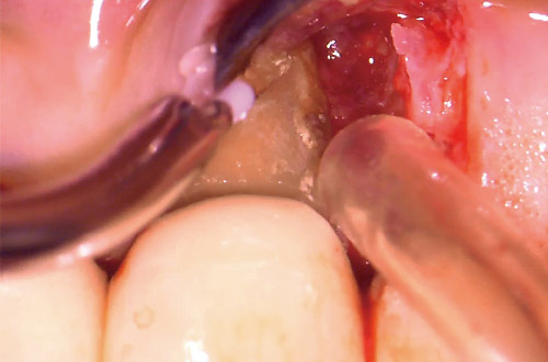 マイクロサージェリーでEr:YAGレーザーによる歯石除去（注水、20Hz、80mJ）の写真