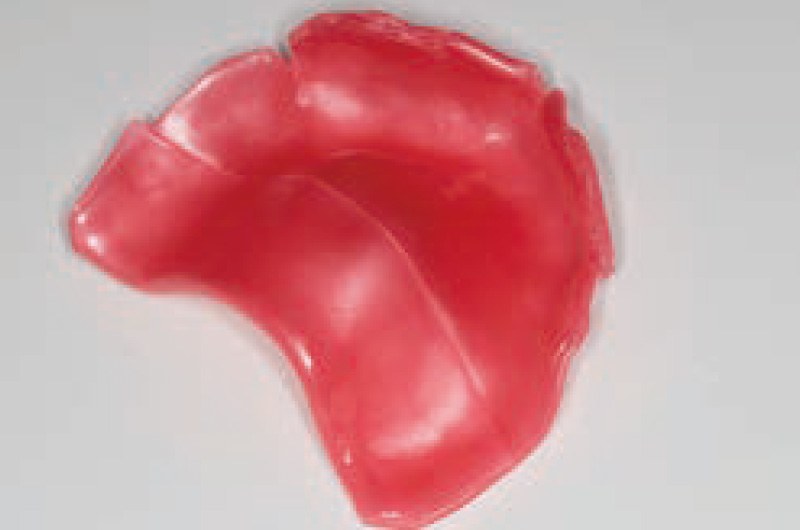 [写真] 上顎はパラフィンワックスを2枚以上を口腔内で圧接して概形を整える