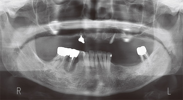 図2　初診時のパノラマX線写真。