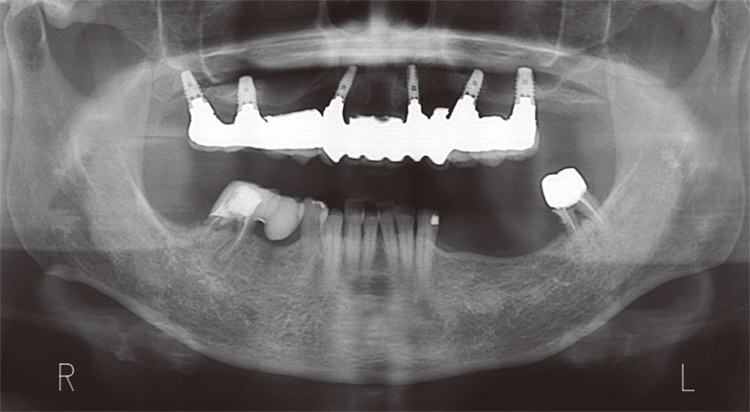 図6　最終補綴セット後、約1年後のパノラマX線写真。
