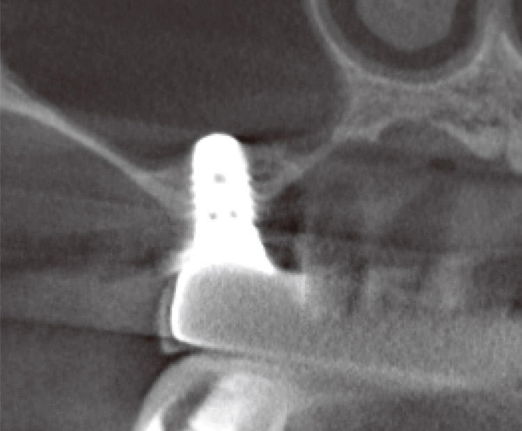 図7　最終補綴セット後、約1年後の 6 のCT写真。