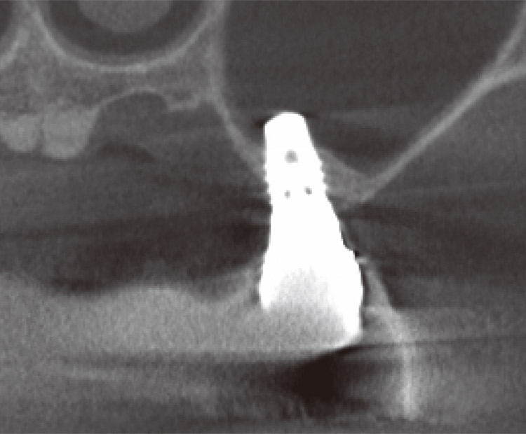 図8　最終補綴セット後、約1年後の6のCT写真。