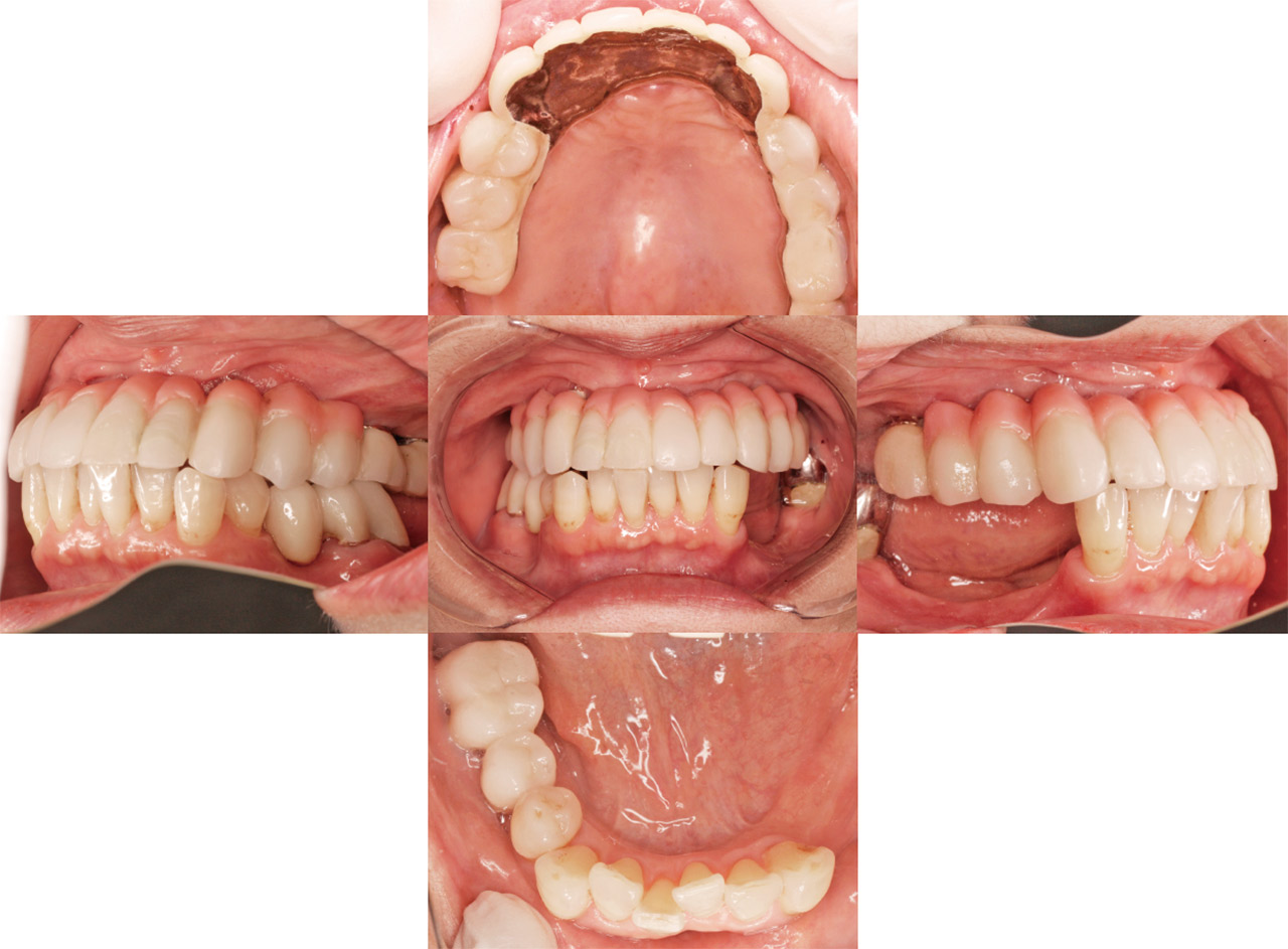 図9　最終補綴セット後、約1年後の口腔内写真。
