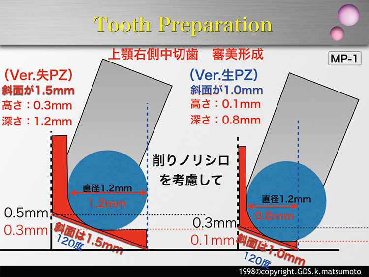 図3　唇側面マージンの形成（使用バー：MP-1）