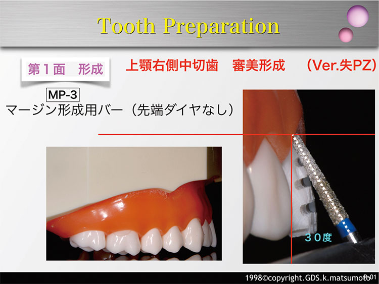図12　歯頸部1/3の形成（使用バー：MP-3）